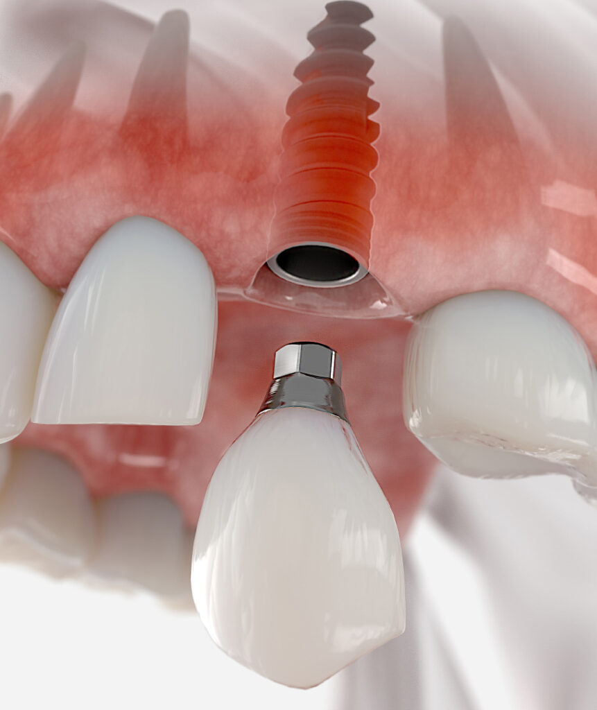 02 prothese dentaire fixe 1